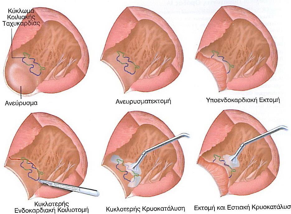 Εικόνα 43: Σχηµατικό διάγραµµα που εµφανίζει τις χειρουργικές επεµβάσεις για την αντιµετώπιση της µετεµ-φραγµατικής κοιλιακής ταχυκαρδίας (ντ) µε ανεύρυσµα στην αριστερή κοιλία.