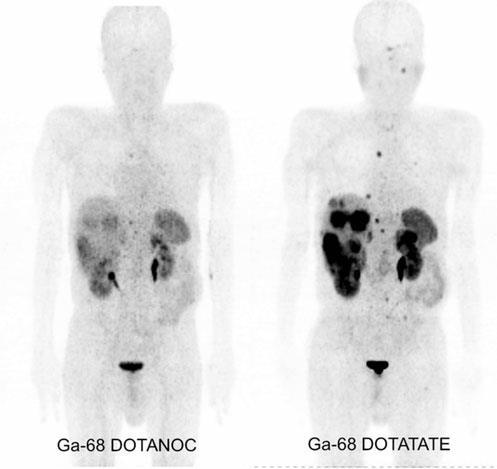 Ga-68DOTANOC Wiild D et al.