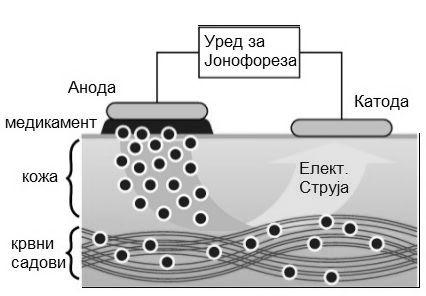 21 Сл. 0.10: Процес на jонофореза. 0.2.3 Jонофореза Внесување на jони од надворешен електролит во организмот со помош на електрично поле се вика jонофореза (лекувачка електрофореза).
