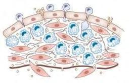 τα οποία και οξειδώνονται. Η οξειδωμένη LDL παραλαμβάνεται από τα μακροφάγα, τα οποία μετά σχηματίζονται σε αφρώδη κύτταρα γεμάτα με LDL χοληστερίνη (βλ. Εικόνα 5)