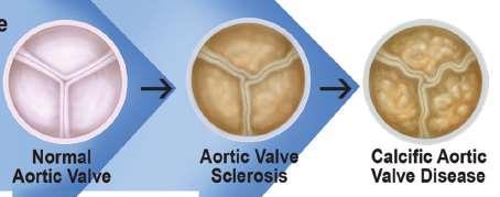 Η εξελικτική πορεία της νόσου Η ασβεστοποιητική νόσος της αορτικής βαλβίδας (CAVD) περιλαμβάνει στο φάσμα της όλα τα στάδια από την αρχική