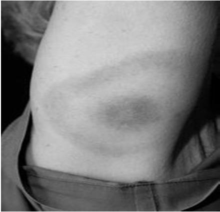 Κλινική εικόνα Πρώϊμη εντοπισμένη Lyme (Early Localised Lyme Βorreliosis) (ημέρες έως εβδομάδες): Erythema migrans (μεταναστευτικό ερύθημα) : εκτεταμένη ερυθηματώδης βλάβη με καθαρό κέντρο στο σημείο