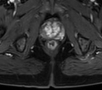 Local staging of prostate