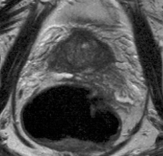 Υπάρχει διήθηση της προστατικής κάψας (Τ2-Τ3) ; MRI : Εκτίμηση της ακεραιότητας και της συνέχειας του χαμηλού σήματος της κάψας