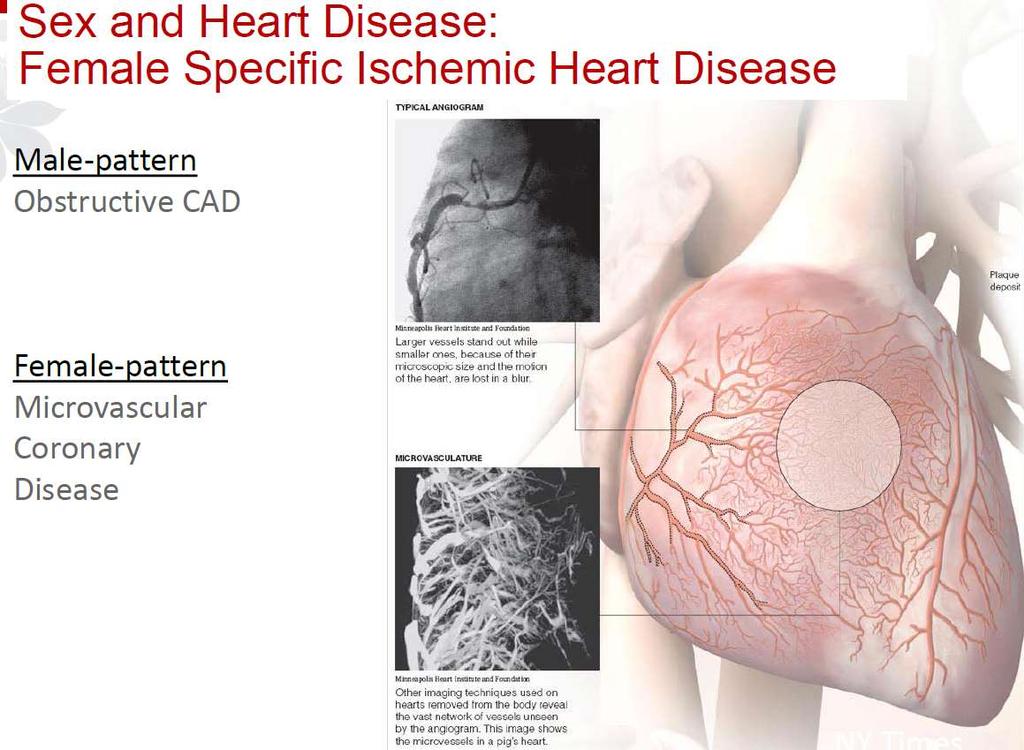 Μ. Gulati, Hypertension