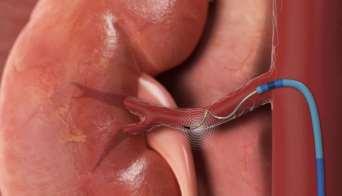 Renal Anatomy Allows a Catheter-Based