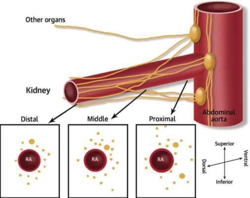 Renal Nerve Distribution Renal nerves may have a positional bias on radial distance from arterial lumen; distal nerves are closer Distal Proximal Prior