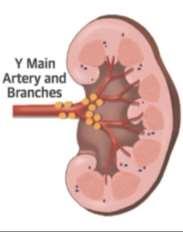 IVY Pre Clinical Trial: Combined Treatment in Main Artery and Branch Vessels in Porcine Model %NE Change ± SD -71 ± 27% -83 ± 21% -92 ± 9% Pre-clinical porcine data