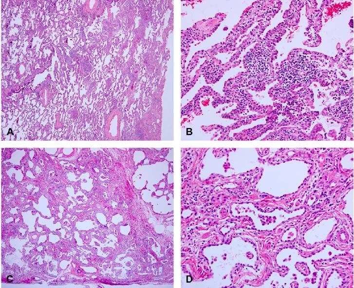 cellular NSIP (type I) and fibrotic NSIP (types