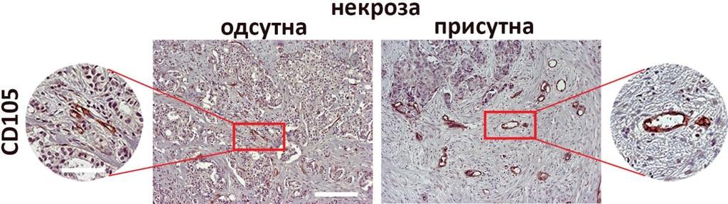 MVD (CD15, x2)/hpf MVD (CD15, x2)/hpf MVD (CD15, x2)/hpf MVD (CD15, x2)/hpf Утицај сигналног пута IL-33/IL-33R на развој некрозе код карцинома дојке Слика 4. Имунохистохемијска процена MVD.
