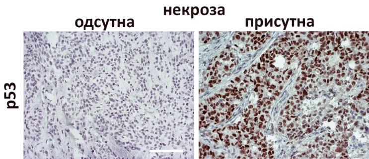 Her2 позитивност је присутна у туморима без обзира да ли су микроскопском анализом уочена поља некрозе (оригинално увећање x1, референтна линија 2μm).