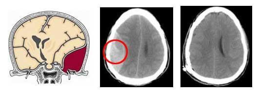 Πρωτοπαθής εγκεφαλική Βλάβη Η κάκωση από άμεση ή έμμεση πλήξη της κεφαλής μπορεί