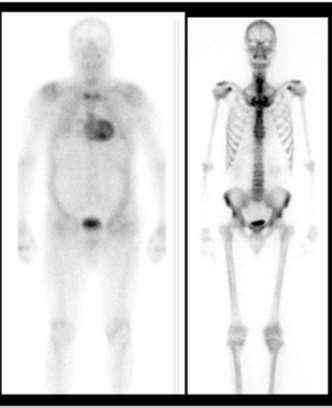 Multimodality Imaging in Restrictive Cardiomyopathies: An EACVI expert consensus