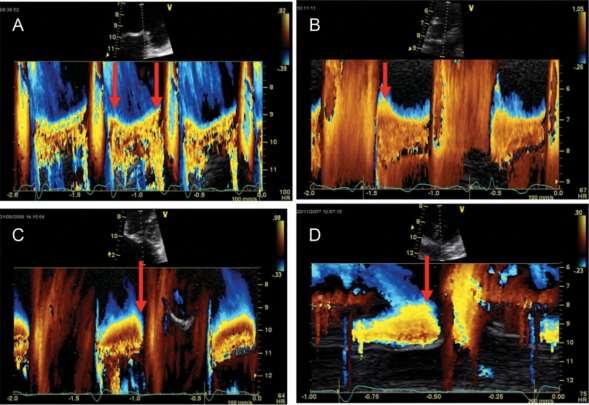 Flow convergence zone changes during systole using