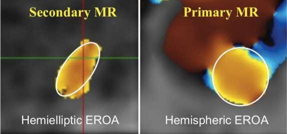 (A and B) Functional MR [(A) early and late peaks