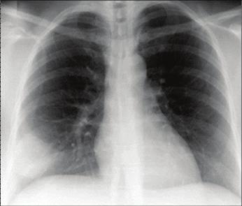 Ιστορικό Γυναίκα 73 ετών που αναφέρει λοίμωξη του ανώτερου αναπνευστικού προ 2 εβδομάδων Ο γιατρός της τής χορήγησε σιπροφλοξασίνη 500mg x 2 για 7 ημέρες Την προηγουμένη της εισαγωγής της αναφέρει