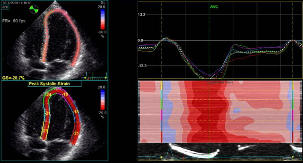 Μυοκαρδιακή παραμόρφωση Speckle Tracking Echocardiography Υπό διερεύνηση Παθολογική παραµόρφωση σχετίζεται µε την αποδεδειγµένη µε EMB µυοκαρδιακή φλεγµονή ακόµα και σε φυσιολογικό ΚΕ Χρησιµοποιείται