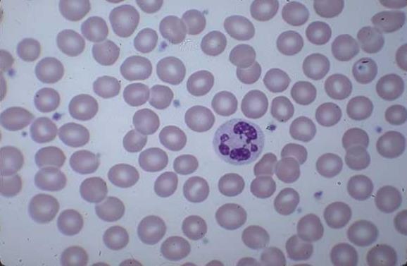 trombocyty v nátere periférnej krvi (100x) megakaryocyty v KD trombocyt neutrofil