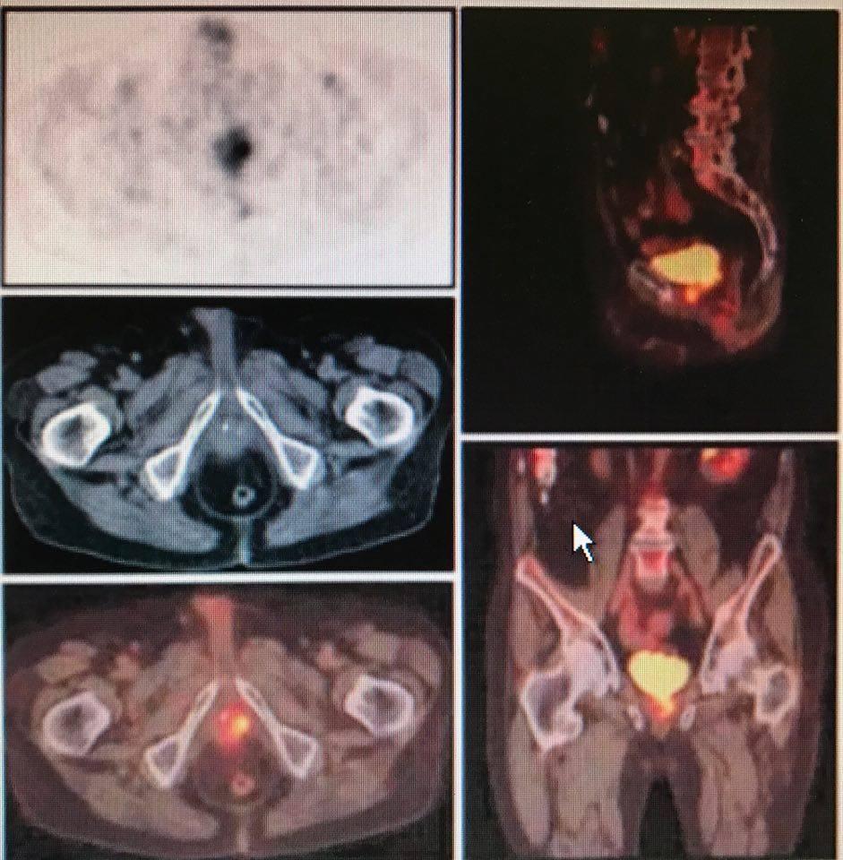 15/1/2018 Καρκίνος προστάτη Γενικά η μεγαλύτερη χρήση της PET στον καρκίνο του προστάτη σχετίζεται με την δυνατότητα της εκτίμησης και του