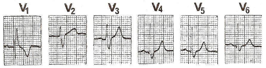 Εικόνα 31 Στην Εικόνα 32 απεικονίζονται τα ΗΚΓτα φυσιολογικής καρδιάς, όπως καταγράφονται από τις έξι προκάρδιες απαγωγές.