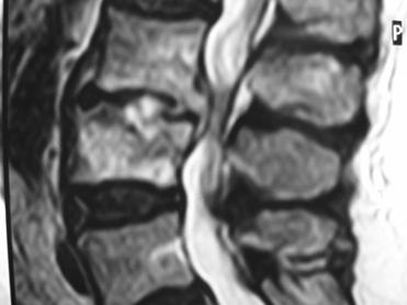 Εργαστηριακός έλεγχος ΤΚΕ >90% WBC <50% CRP >90% Αιμοκαλλιέργειες θετικές <25% Έλεγχος βρουκέλλωσης* Βιοψία δια βελόνης υπό απεικονιστικό έλεγχο Καλλιέργεια ιστού και άμεση αναζήτηση κοινών