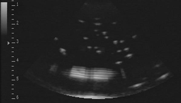 Microbubbles (cavitation)