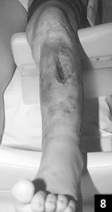 αγωγή; von Eiff C et al Clin Infect Dis, 1997;25;1250-1 Biofilm Παθογόνα που παράγουν biofilm S.