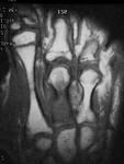 CT scan & οστεομυελίτιδα Καλή απεικόνιση της φλοιώδους μοίρας του οστού, του περιοστέου και των μαλακών μορίων καθώς και του συριγγίου. Αξιολόγηση ύπαρξης απολύματος.
