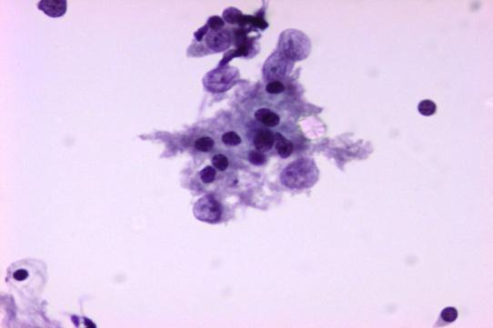 2. Θυρεοειδύτιδα Hashimoto Κυτταρικό διϊταξη ανϊλογη