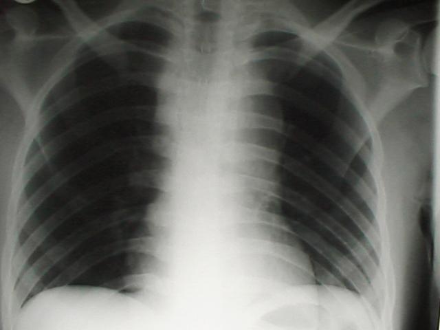 221 Εικόνα 1. Στα αριστερά απλή προσθιοπίσθια ακτινογραφία θώρακα ασθενούς με τραυματική ρήξη του ισθμού της αορτής.
