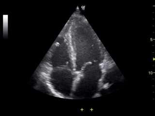 Υπερηχογράφημα καρδιάς LVEDD (mm) 46 LVESD (mm) 29 IVS (mm) 11 PW (mm)