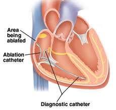 (ablation) αποτελεί θεραπεία επιλογής για
