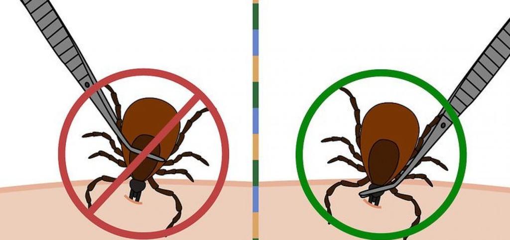 Νόσος Lyme Borrelia burgdorferi Μόνο εάν 1.