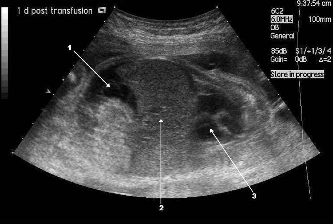 Parvo B19 και εγκυμοσύνη Συγγενής λοίμωξη από Parvo B19 μπορεί να γίνει μόνον επί οξείας νοσήσεως της εγκύου Η συχνότητα μετάδοσης στο έμβρυο είναι 30-50%. Η νοσηρότητα μικρότερη >25W(peak 17-24 εβδ.