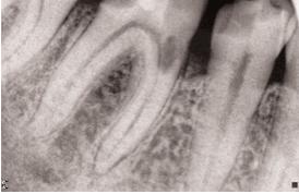 90 Δημόπουλος και συν χή του δοντιού, η οποία, όταν επεκταθεί σε μεγάλο βαθμό, προκαλεί σημαντική μείωση του μήκους της ρίζας, καθιστώντας την πρόγνωση του δοντιού αμφίβολη.