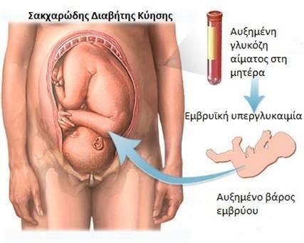 1.2 Ολδ ησμ - πδπκζα ησμ - βηα έα Πλυδηβ δϊΰθπ β Χμ α χα α Κ (Gestational Diabetes Mellitus-GDM) κλέα αδ β δα αλαξά κυ η αίκζδ ηκτ βμ ΰζυεσαβμ πκδεέζβμ ίαλτ β αμ πκυ πλπ κ ηφαθέα αδ ά δαΰδΰθυ ε αδ