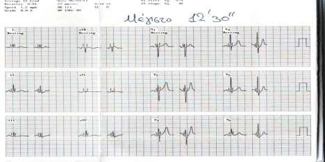 ΑΠ 110/80 mmhg Κ :3.