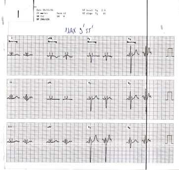 105/60 mmhg Κ :4,3 Rest Mέγιστο της