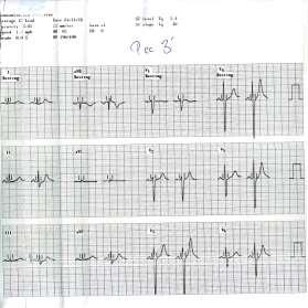 126/λεπτό, ΑΠ 90/60 mmhg εμφάνιση οξύαιχμων Τ