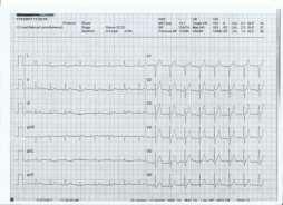 σφ 100/λ ΑΠ 135/80 mmhg