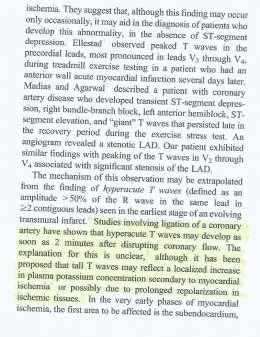 ΠΑΘΟΦΥΣΙΟΛΟΓΙΚΗ ΕΡΜΗΝΕΙΑ Ο μηχανισμός της εμφάνισης των οξύαιχμων Τ στη διάρκεια της δοκιμασίας κοπώσεως παραμένει ασαφής Ωστόσο Μελέτες που περιλαμβάνουν την απολίνωση στεφανιαίας αρτηρίας δεικνύουν