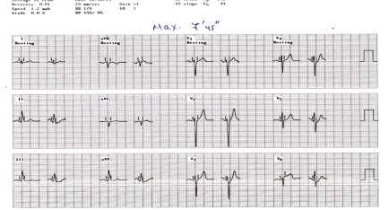 ΑΠ 115/70 mmhg,, K: 4,2 Μέγιστο της