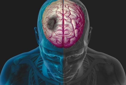 ΟΡΙΣΜΟΣ Ο όρος Εγκεφαλικό Επεισόδιο χρησιμοποιείται για να περιγράψει το γεγονός της αιφνίδιας και δραματικής ανάπτυξης ενός νευρολογικού ελλείμματος ως αποτέλεσμα παθολογικής