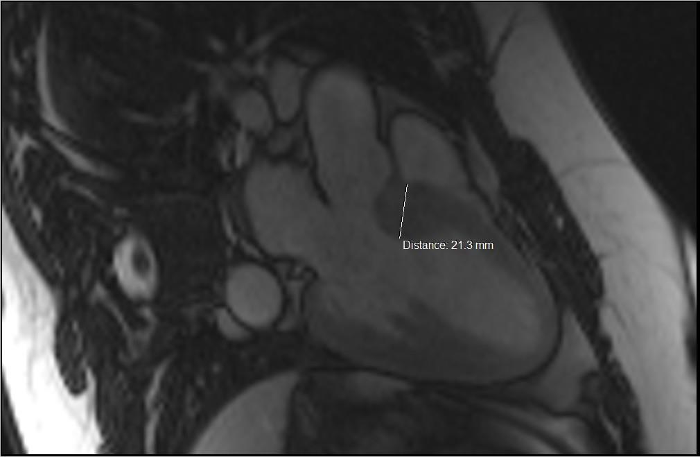 MRI καρδιάς