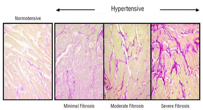 Hypertrophy and arrhythmias: the fundamental concept Hypertrophy of cardiac muscle in hypertensive patients is characterized not only by increased myocardial mass, but also by proliferation of