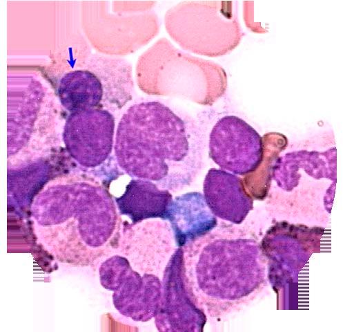 resultant cytopenias and related complications Macrocytic anemia is the most common