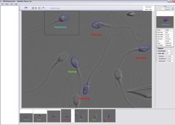 IMSI Intracytoplasmic