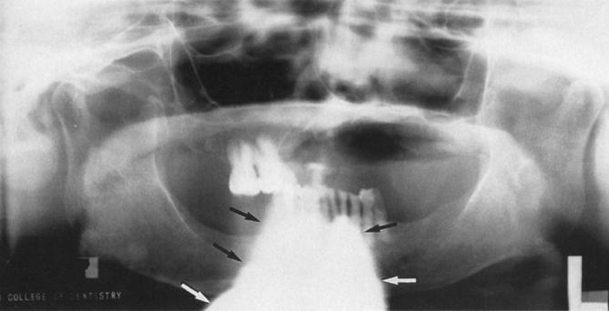 Αρτιφακτ μολύβδινης ποδιάς (From Haring J, Jansen L: Dental