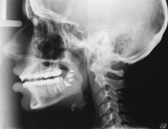 Πλάγια κεφαλομετρική λήψη (From Haring J, Jansen L: Dental radiography: principles and techniques, ed 2,