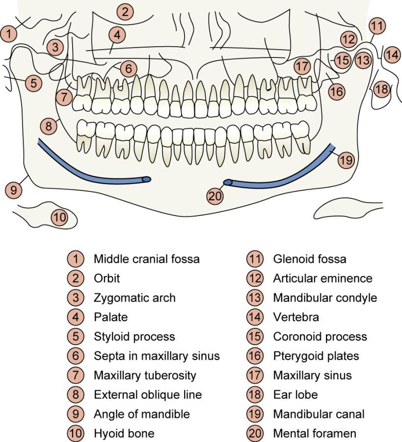 1 Μέσος κρανιακός βόθρος 11 Γληνοειδής βόθρος 2 Οφθαλμικός κόγχος 12 Αρθρική προβολή 3 Ζυγωματικό τόξο 13 Κόνδυλος της κάτω γνάθου 4 Υπερώα 14 Σπόνδυλος 5 Στυλοειδής απόφυση 15 Κορωνοειδής απόφυση 6